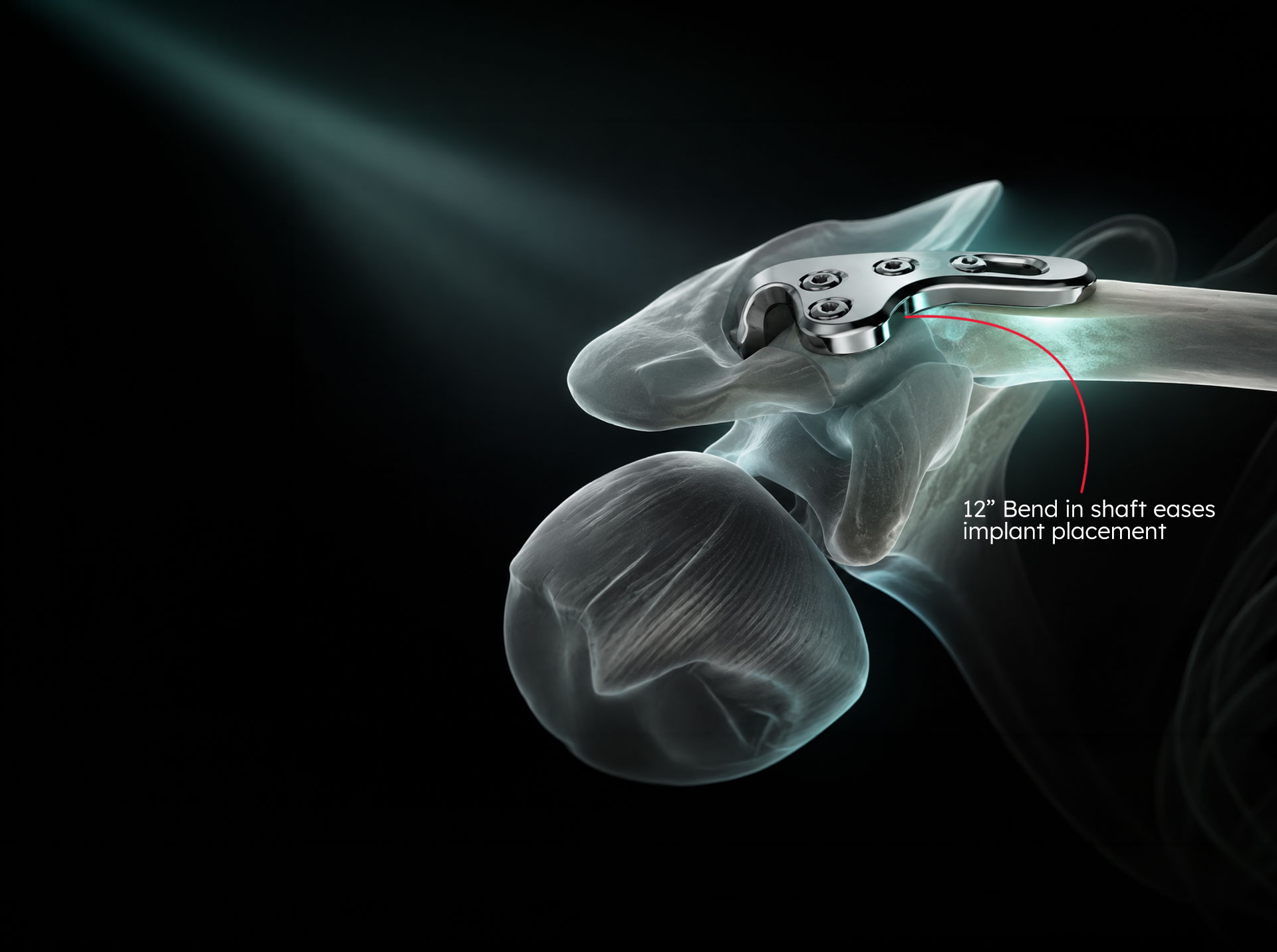 Cortical Screw