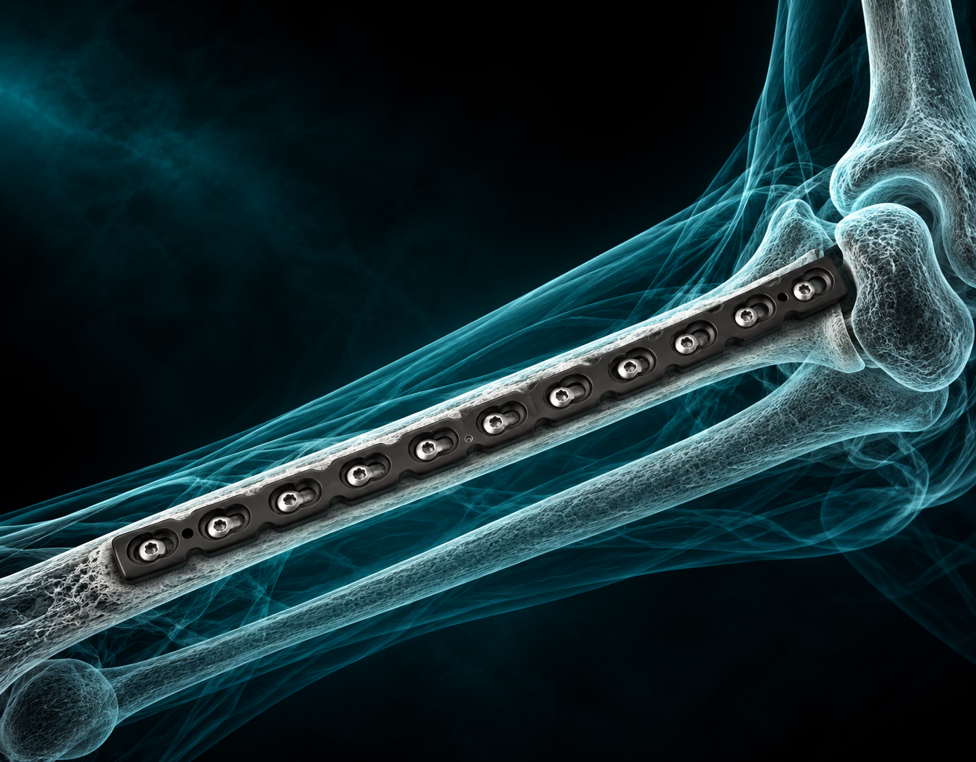 3.5MM Reconstruction LCP