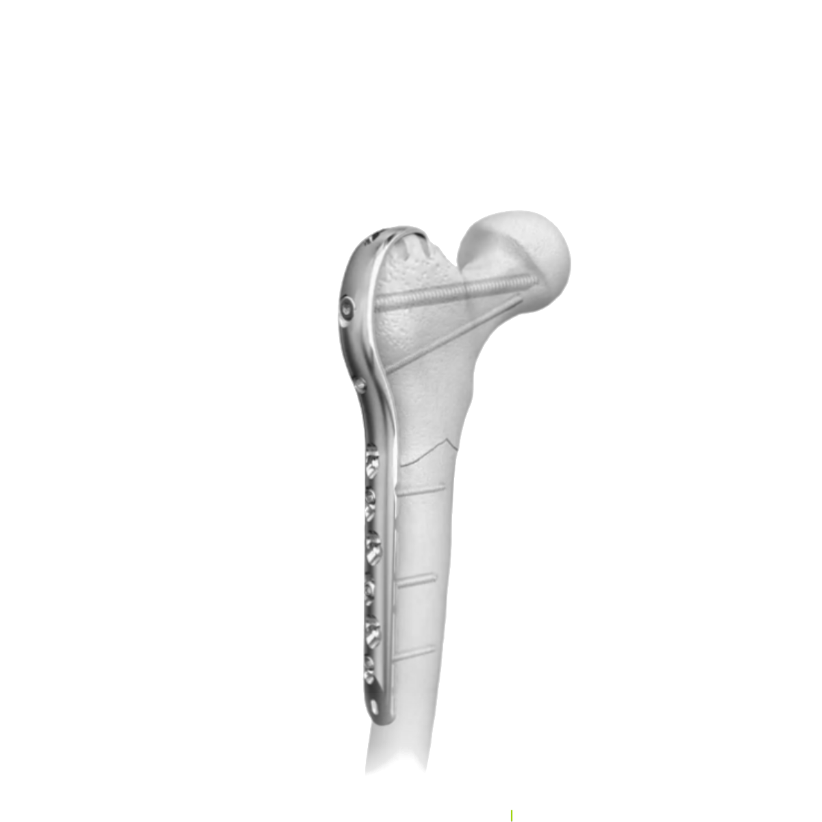 Proximal Femur Hook LCP