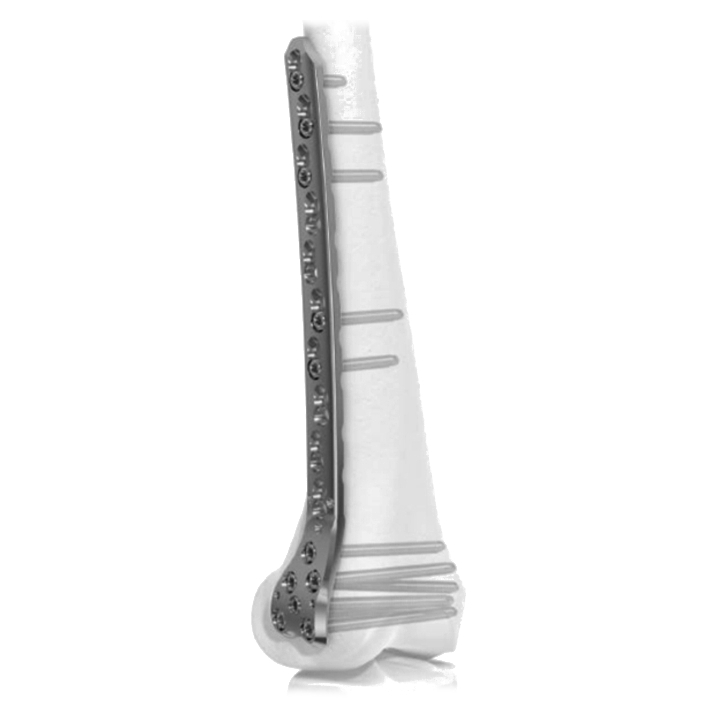 Ø5.0MM Condylar LCP