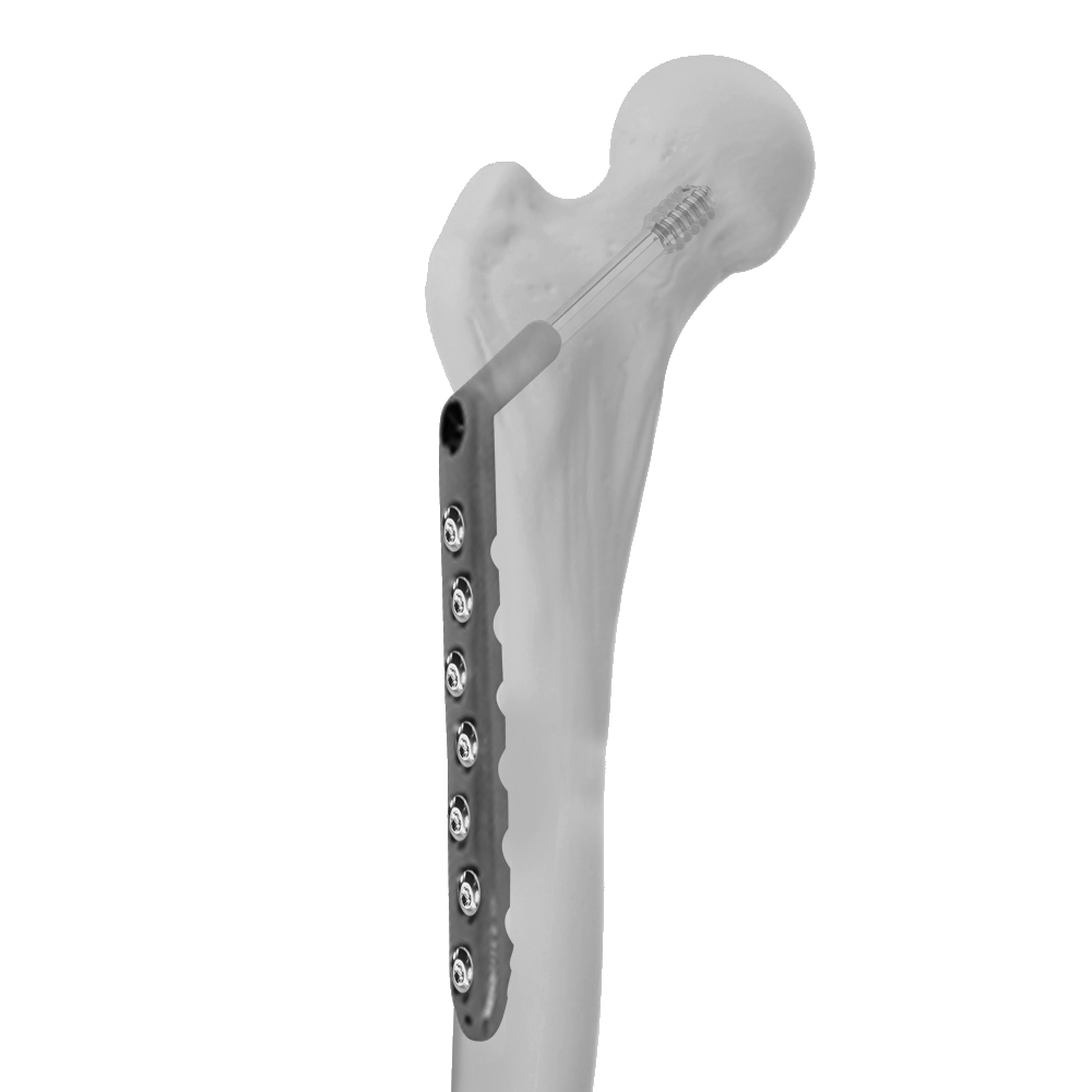 Ø5.0MM Dhs LCP