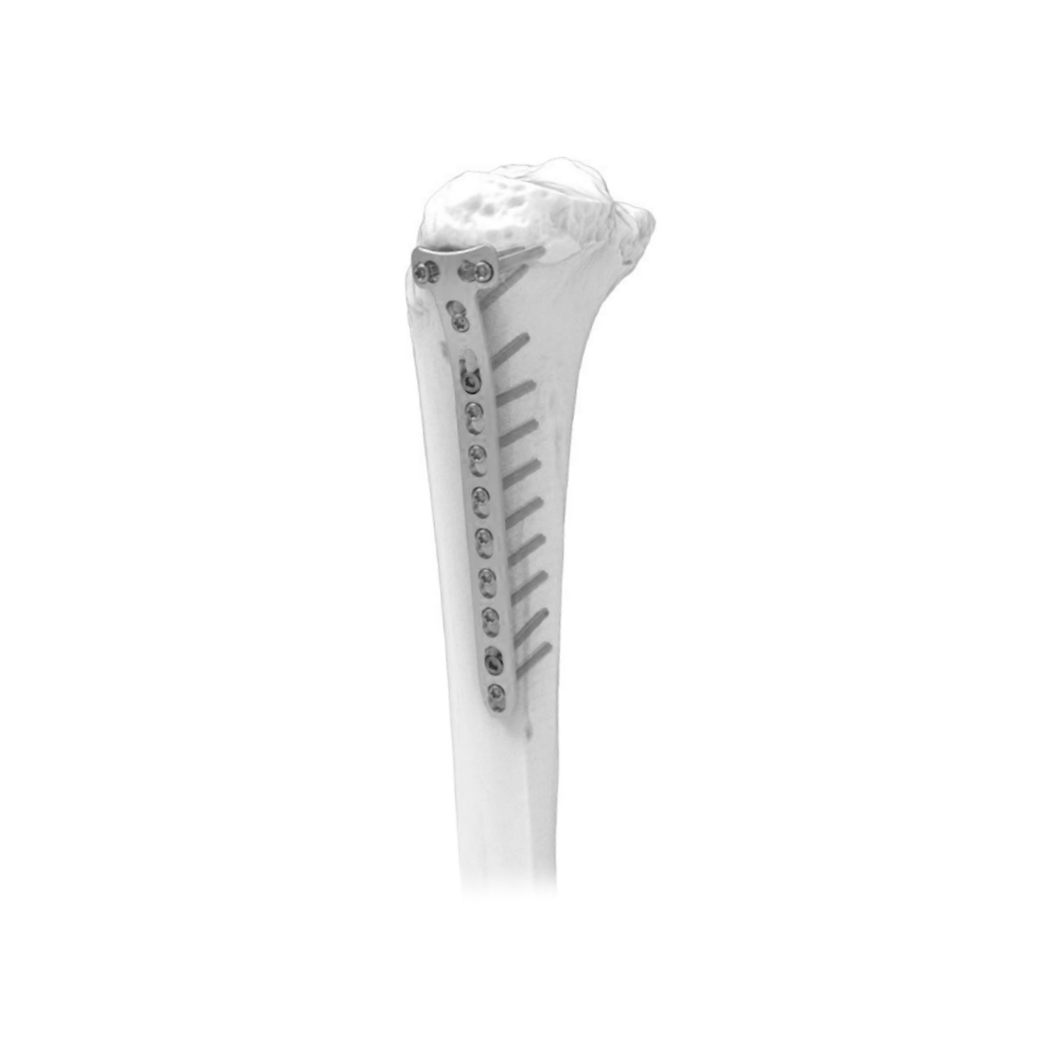 Ø5.0MM T LCP