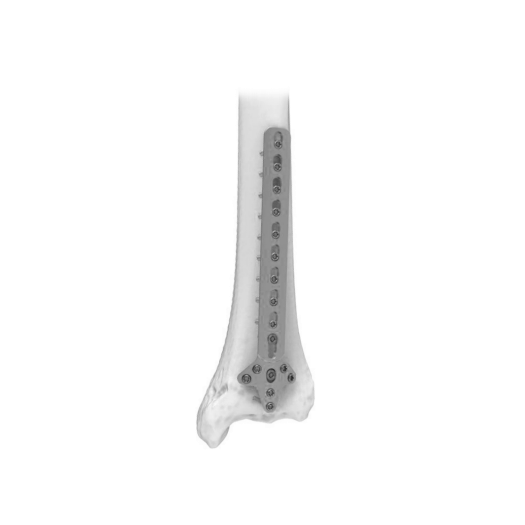 Ø3.5MM Cloverleaf LCP