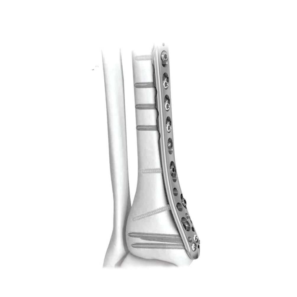Ø3.5MM Medial Distal Tibia LCP