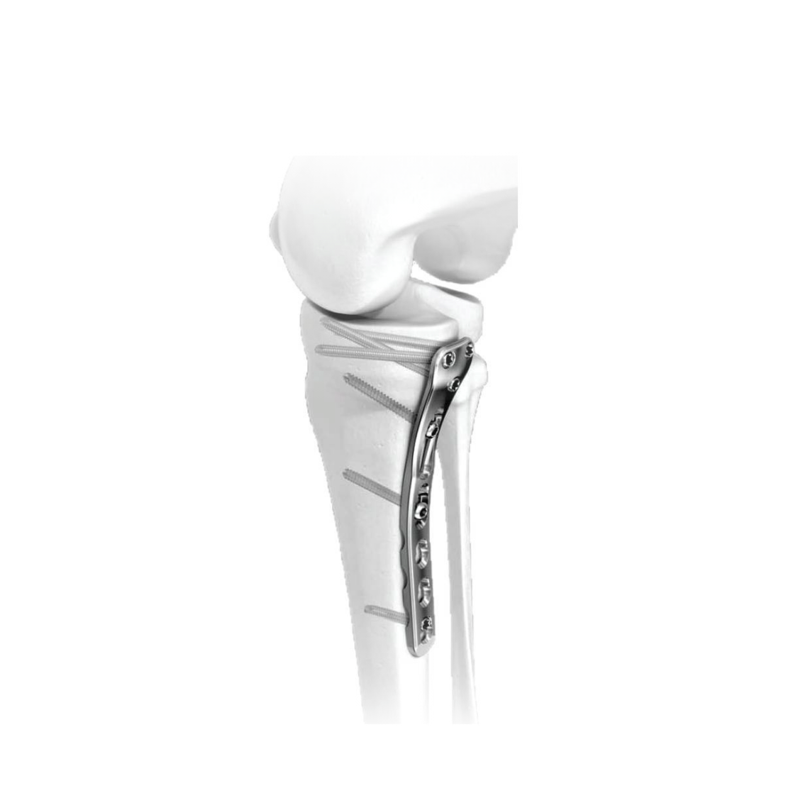 Ø3.5MM Postero-medial Proximal Tibia LCP