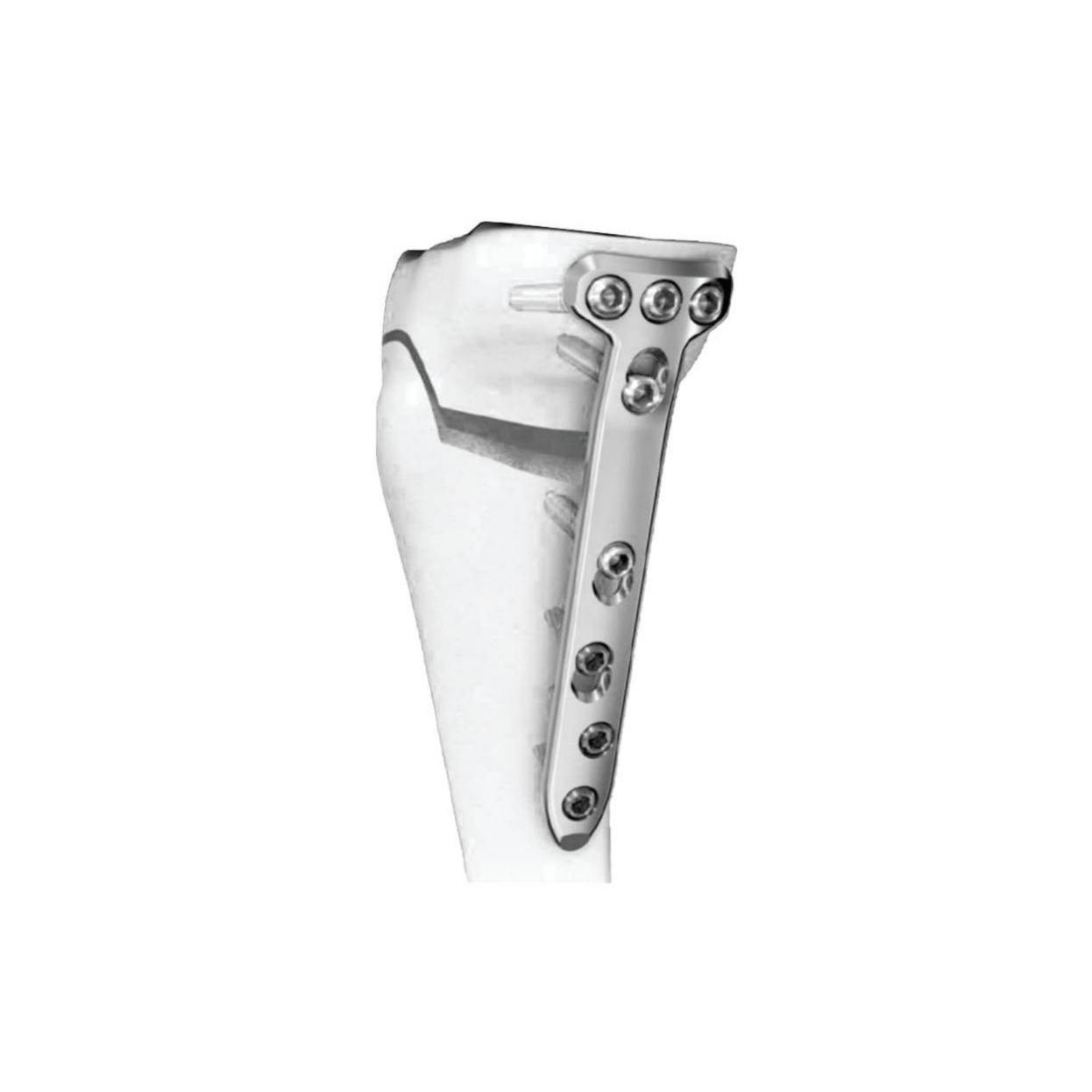 Ø5.0MM Medial High Tibia LCP